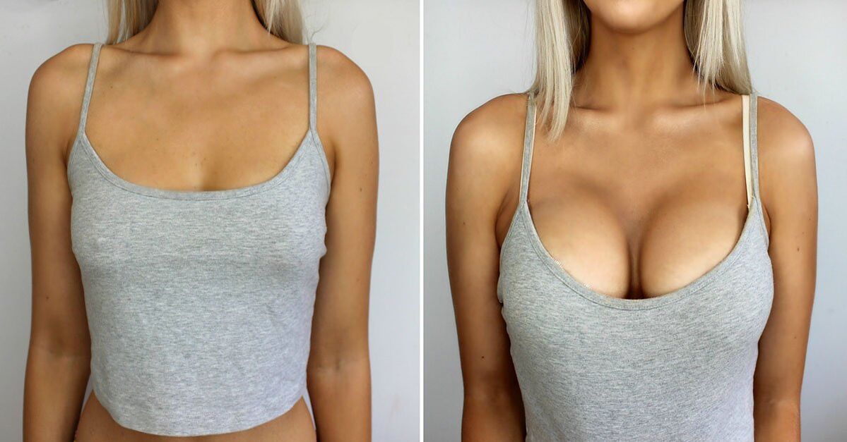 Before and after breast enhancement
