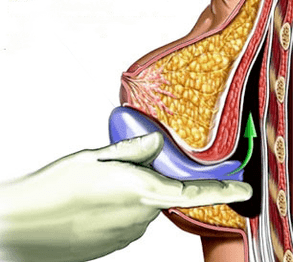 breast augmentation implantation