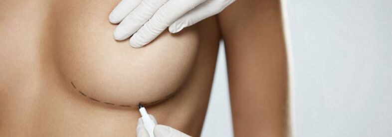 Breast marking before lipofilling