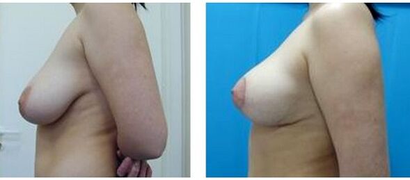 before and after surgical breast augmentation