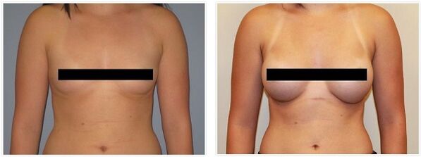 breast before and after surgery