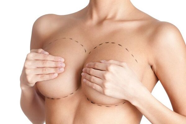 margin for breast augmentation surgery