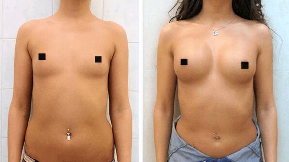 photographs before and after surgical breast augmentation